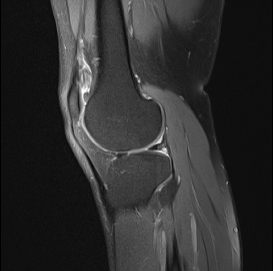 Sagittal knee MRI (PD fat-sat)